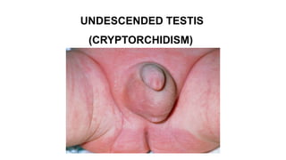 UNDESCENDED TESTIS
(CRYPTORCHIDISM)
 