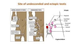Site of undescended and ectopic testis
 