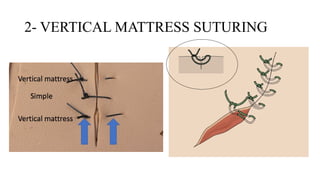 Suturing Patterns Common Suturing Techniques and Patterns in Surgery | Art of Suturing | PPTX