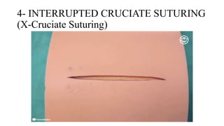 Suturing Patterns Common Suturing Techniques and Patterns in Surgery | Art of Suturing | PPTX