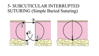 Suturing Patterns Common Suturing Techniques and Patterns in Surgery | Art of Suturing | PPTX