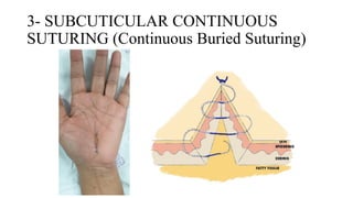 Suturing Patterns Common Suturing Techniques and Patterns in Surgery | Art of Suturing | PPTX