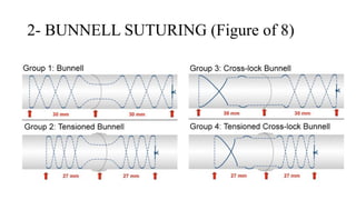 Suturing Patterns Common Suturing Techniques and Patterns in Surgery | Art of Suturing | PPTX