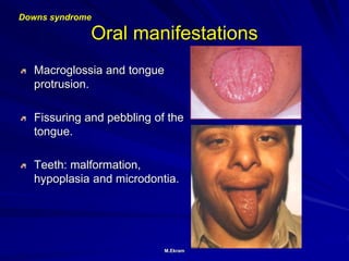 M.Ekram
Oral manifestations
Macroglossia and tongue
protrusion.
Fissuring and pebbling of the
tongue.
Teeth: malformation,
hypoplasia and microdontia.
Downs syndrome
 