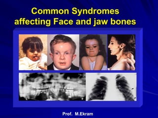 M.Ekram
Common Syndromes
affecting Face and jaw bones
Prof. M.Ekram
 