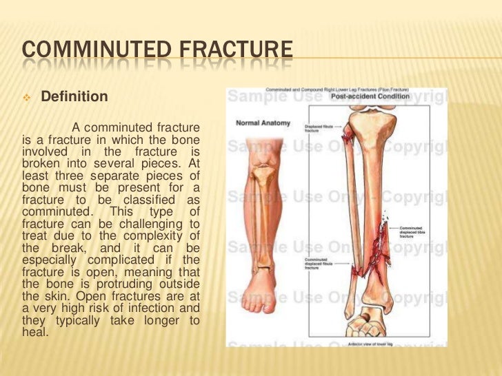 meaning of fractured in english