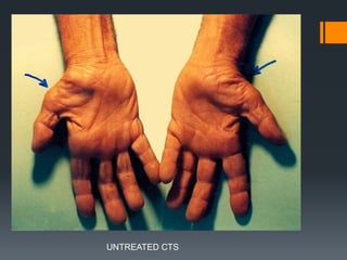 UNTREATED CTS
 