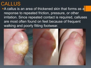 CALLUS
A callus is an area of thickened skin that forms as a
response to repeated friction, pressure, or other
irritation. Since repeated contact is required, calluses
are most often found on feet because of frequent
walking and poorly fitting footwear.
 