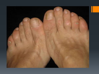 Common Upper and Lower extrimity disorders