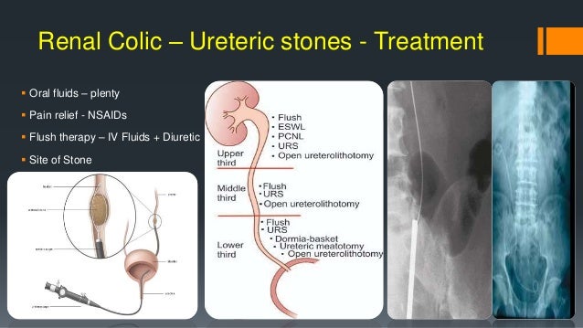 Common urological emergencies appendicitis diagram 