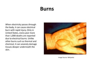 Burns
When electricity passes through
the body, it can cause electrical
burn with rapid injury. Only in
United States, every year more
than 1,000 deaths are reported
due to electrical burns. Unlike
other burns such as thermal and
chemical, it can severely damage
tissues deeper underneath the
skin.
Image Source: Wikipedia
 