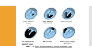 Chronic Otitis Media- mucosal type( UG) .pdf