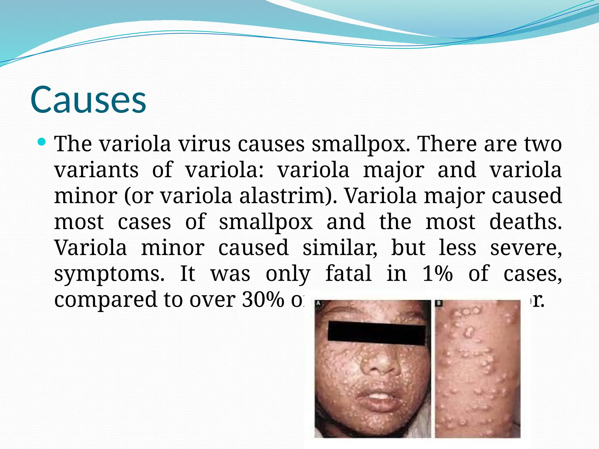 Causes
 The variola virus causes smallpox. There are two
variants of variola: variola major and variola
minor (or variola alastrim). Variola major caused
most cases of smallpox and the most deaths.
Variola minor caused similar, but less severe,
symptoms. It was only fatal in 1% of cases,
compared to over 30% of cases of variola major.
 