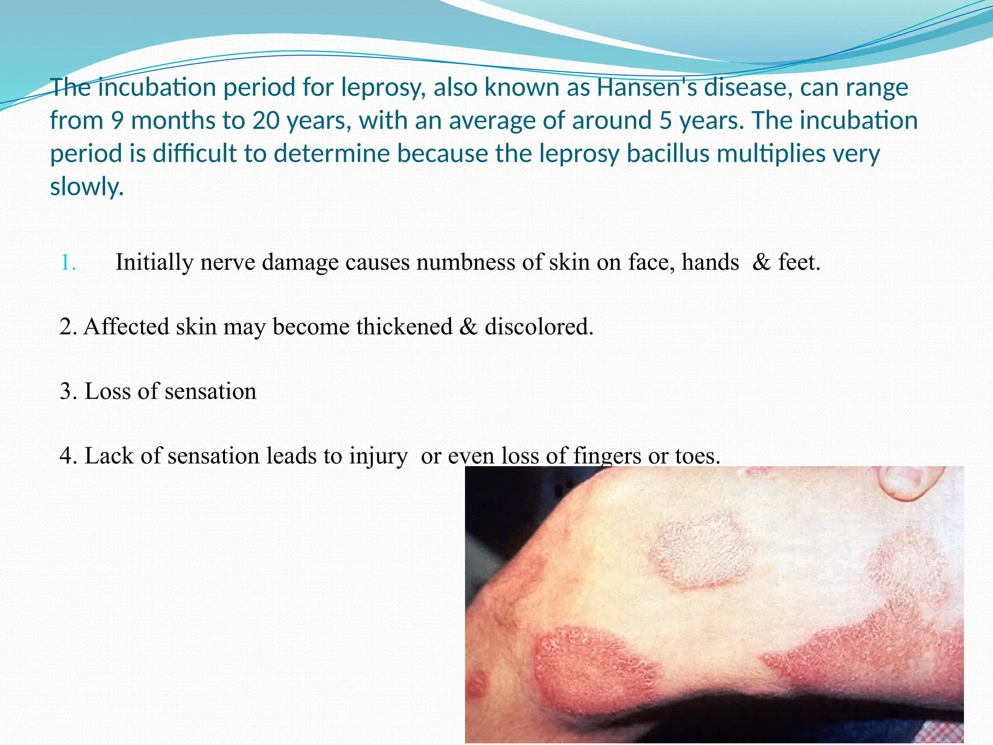 The incubation period for leprosy, also known as Hansen's disease, can range
from 9 months to 20 years, with an average of around 5 years. The incubation
period is difficult to determine because the leprosy bacillus multiplies very
slowly.
1. Initially nerve damage causes numbness of skin on face, hands & feet.
2. Affected skin may become thickened & discolored.
3. Loss of sensation
4. Lack of sensation leads to injury or even loss of fingers or toes.
 
