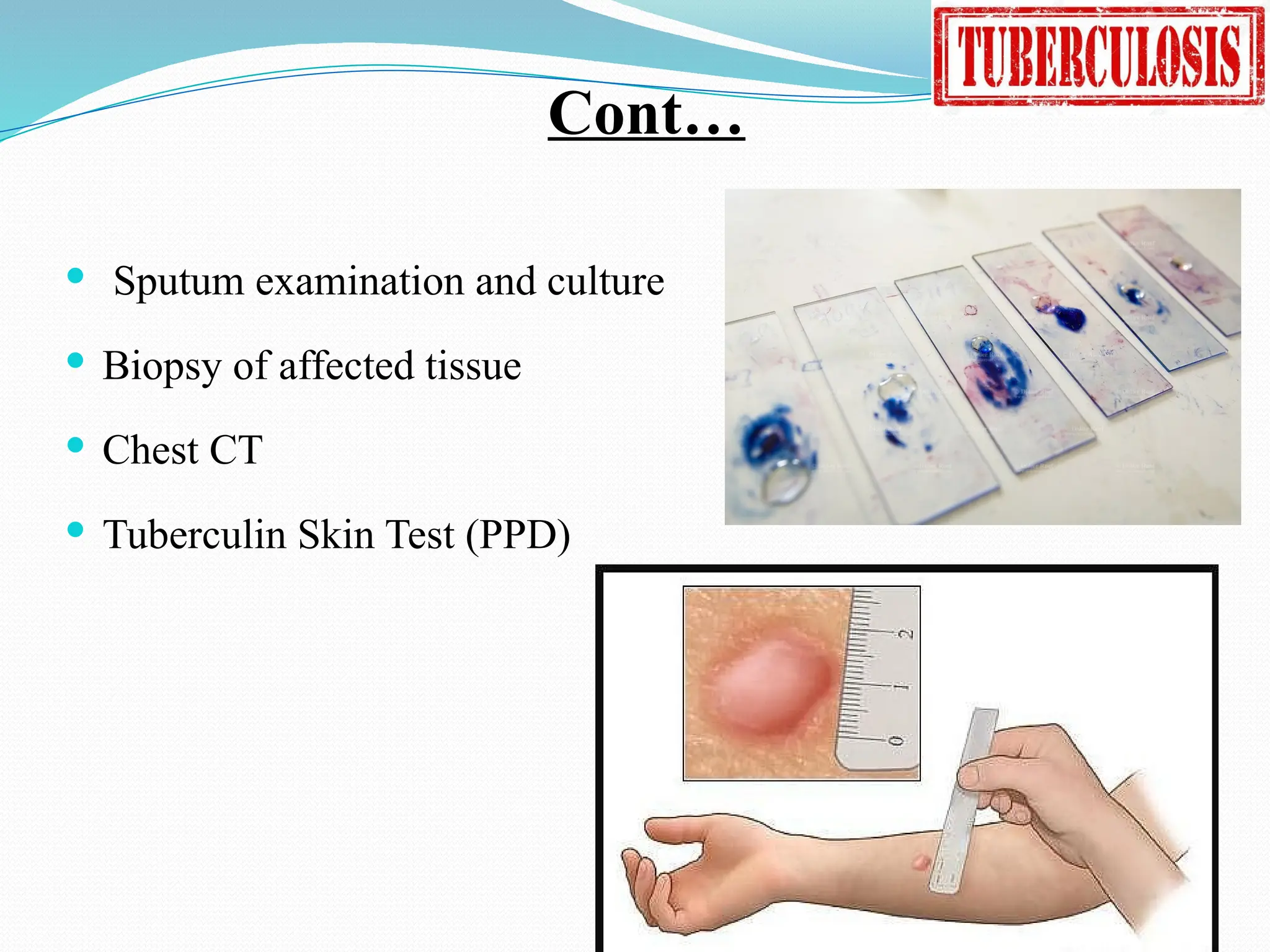 Cont…
 Sputum examination and culture
 Biopsy of affected tissue
 Chest CT
 Tuberculin Skin Test (PPD)
 