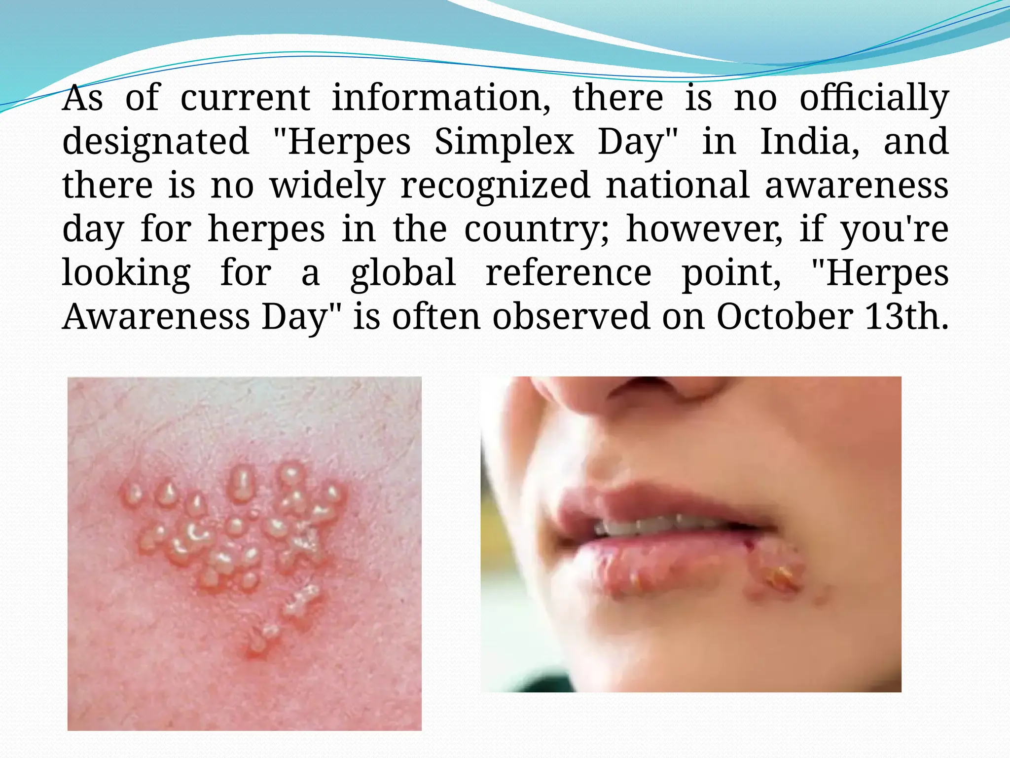 As of current information, there is no officially
designated "Herpes Simplex Day" in India, and
there is no widely recognized national awareness
day for herpes in the country; however, if you're
looking for a global reference point, "Herpes
Awareness Day" is often observed on October 13th.
 
