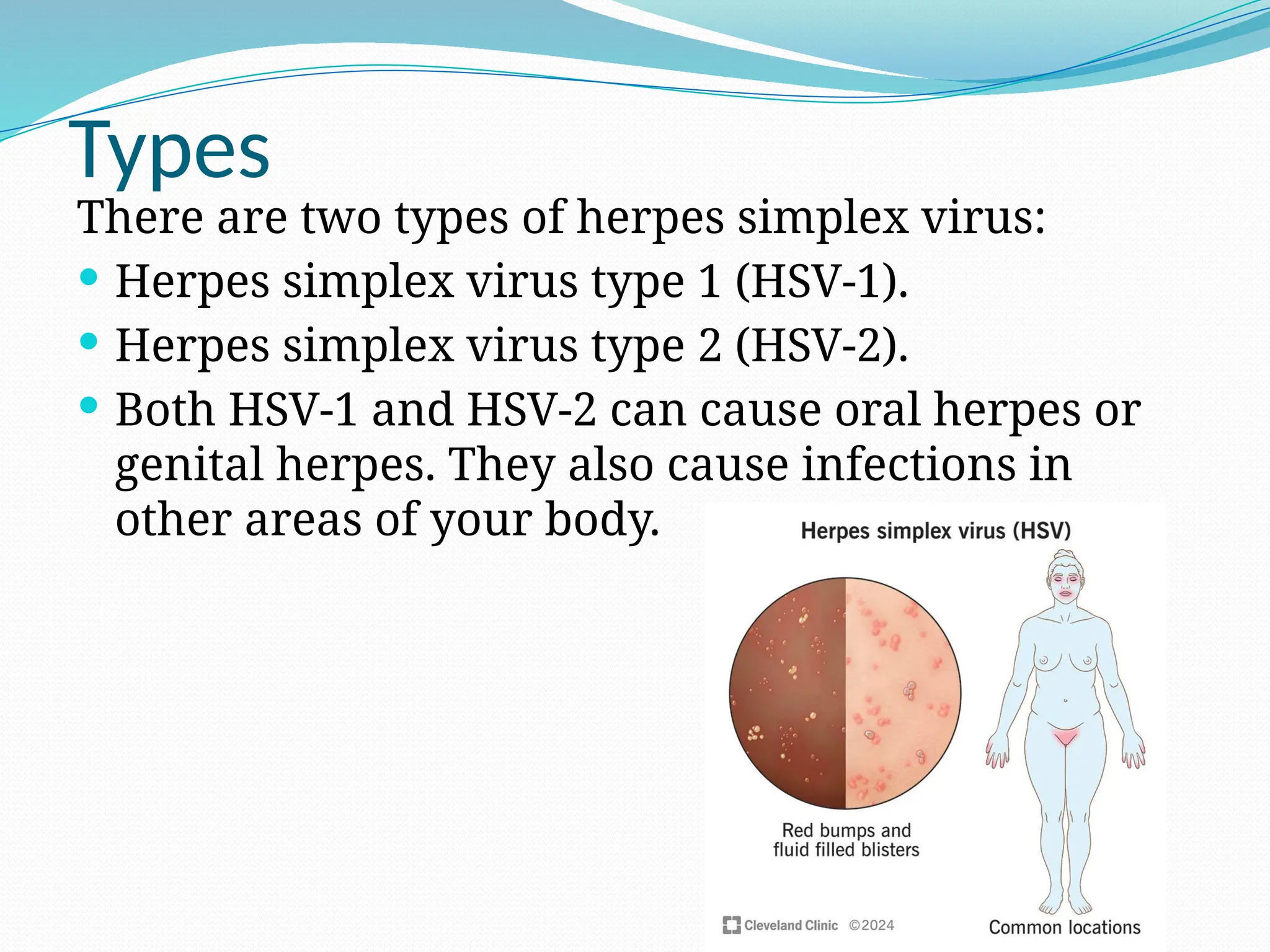 Types
There are two types of herpes simplex virus:
 Herpes simplex virus type 1 (HSV-1).
 Herpes simplex virus type 2 (HSV-2).
 Both HSV-1 and HSV-2 can cause oral herpes or
genital herpes. They also cause infections in
other areas of your body.
 