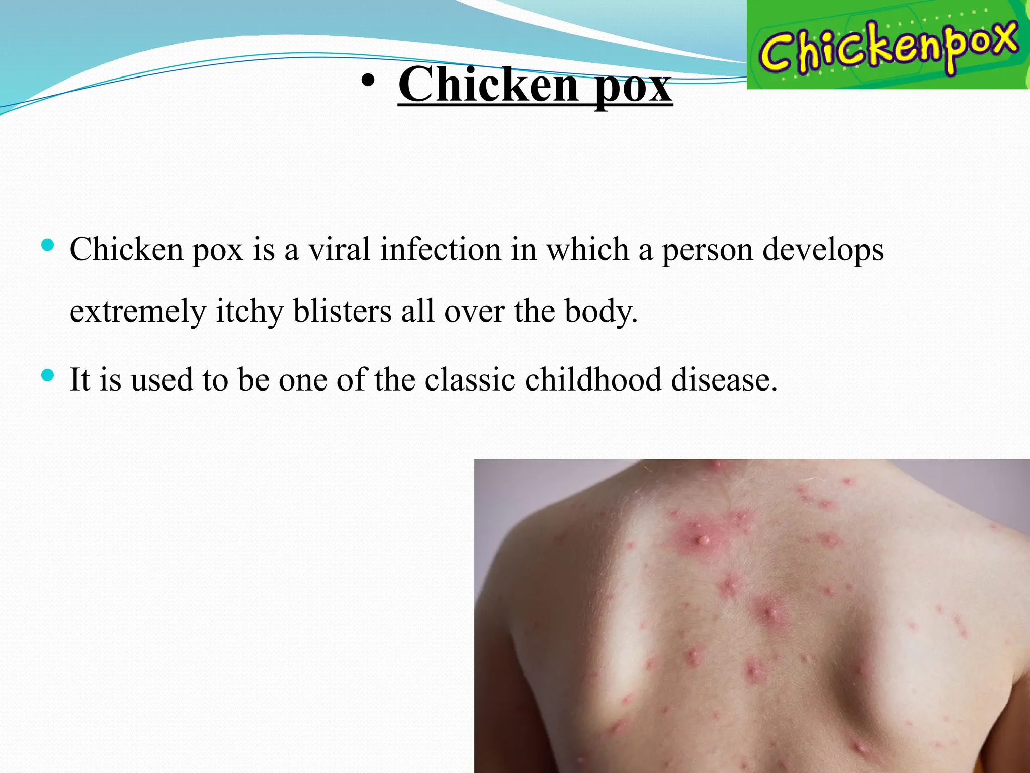 • Chicken pox
 Chicken pox is a viral infection in which a person develops
extremely itchy blisters all over the body.
 It is used to be one of the classic childhood disease.
 