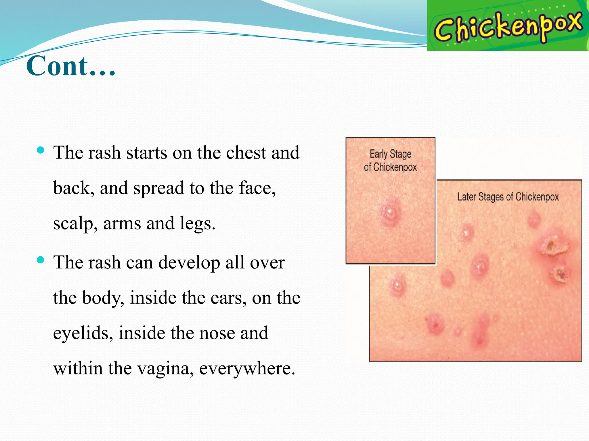 Cont…
 The rash starts on the chest and
back, and spread to the face,
scalp, arms and legs.
 The rash can develop all over
the body, inside the ears, on the
eyelids, inside the nose and
within the vagina, everywhere.
 