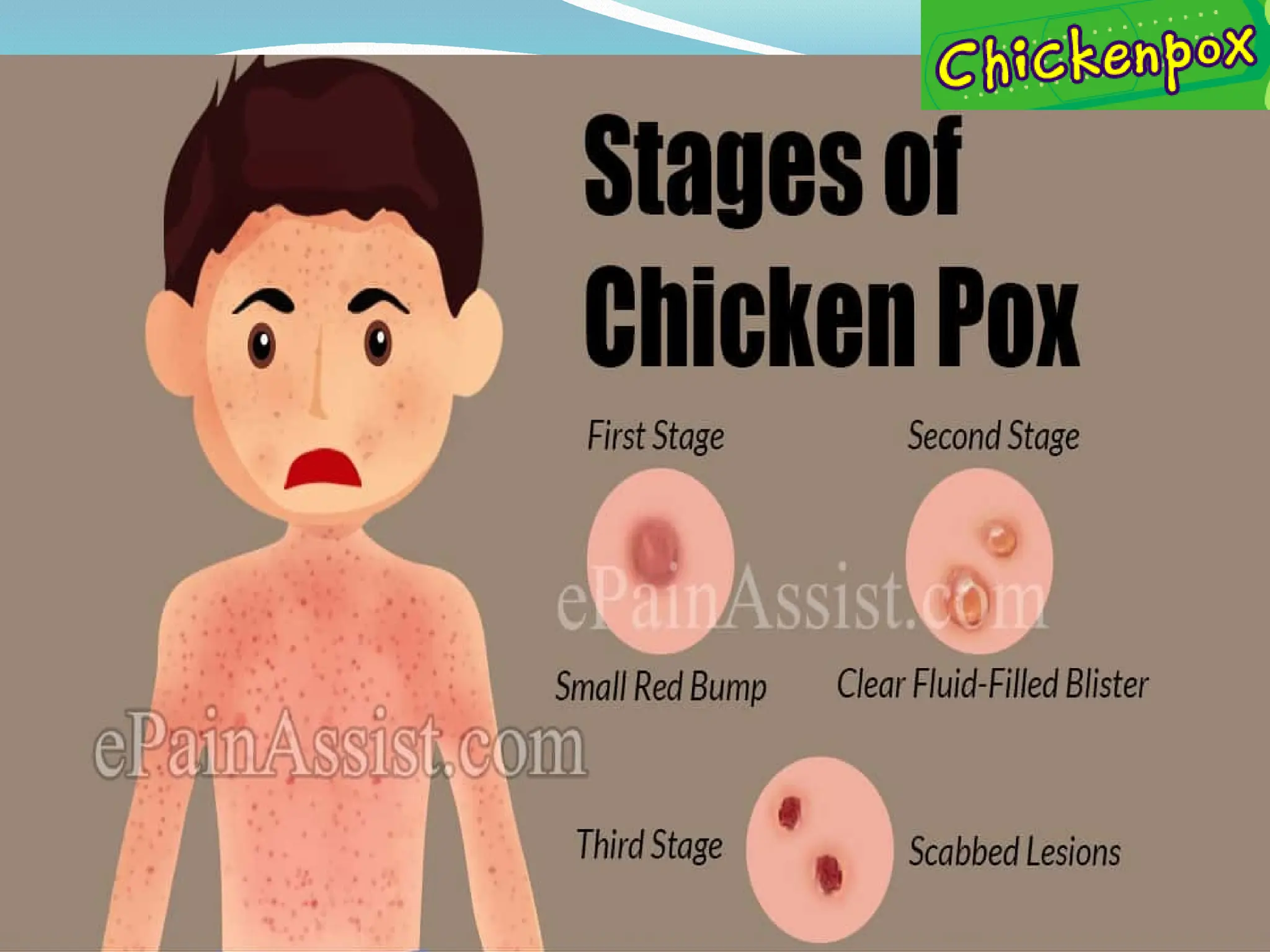 Stages of Chicken Pox
 