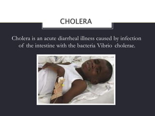 Cholera is an acute diarrheal illness caused by infection
of the intestine with the bacteria Vibrio cholerae.
 