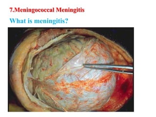 7.Meningococcal Meningitis
What is meningitis?
 