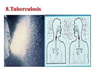 8.Tuberculosis
 