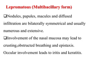 Lepromatous (Multibacillary form)
Nodules, papules, macules and diffused
infiltration are bilaterally symmetrical and usually
numerous and extensive.
Involvement of the nasal mucosa may lead to
crusting,obstructed breathing and epistaxis.
Occular involvement leads to iritis and keratitis.
 