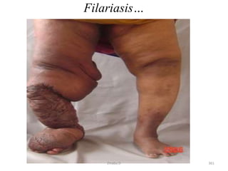 Filariasis…
361
Zinabu D
 