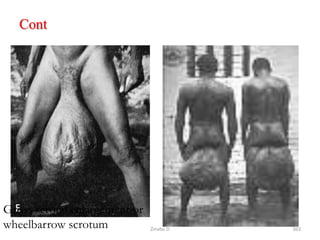 Cont
Gross scrotal enlargement or
wheelbarrow scrotum 363
Zinabu D
 