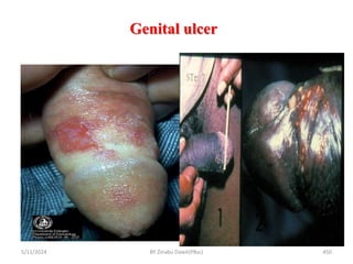 Genital ulcer
5/11/2024 450
BY Zinabu Dawit(PBsc)
 