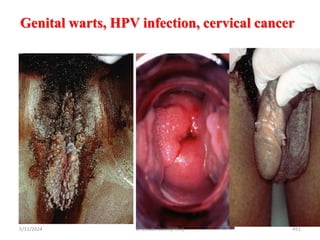 Genital warts, HPV infection, cervical cancer
5/11/2024 451
BY Zinabu Dawit(PBsc)
 