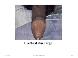 Urethral discharge
5/11/2024 457
BY Zinabu Dawit(PBsc)
 