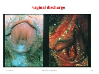 vaginal discharge
5/11/2024 466
© Teaching-aids at low cost
BY Zinabu Dawit(PBsc)
 