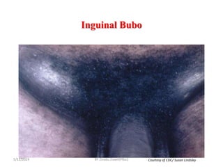 Inguinal Bubo
5/11/2024
483
Courtesy of CDC/ Susan Lindsley
BY Zinabu Dawit(PBsc)
 