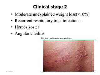 Clinical stage 2
5/11/2024 532
• Moderate unexplained weight loss(<10%)
• Recurrent respiratory tract infections
• Herpes zoster
• Angular cheilitis
BY Zinabu Dawit(PBsc)
 