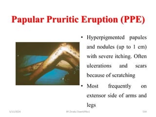 Papular Pruritic Eruption (PPE)
5/11/2024 534
• Hyperpigmented papules
and nodules (up to 1 cm)
with severe itching. Often
ulcerations and scars
because of scratching
• Most frequently on
extensor side of arms and
legs
BY Zinabu Dawit(PBsc)
 