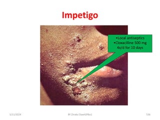 Impetigo
5/11/2024 536
•Local antiseptics
•Cloxacilline 500 mg
4x/d for 10 days
BY Zinabu Dawit(PBsc)
 