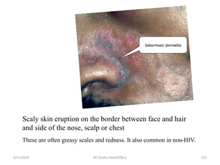 Scaly skin eruption on the border between face and hair
and side of the nose, scalp or chest
These are often greasy scales and redness. It also common in non-HIV.
5/11/2024 537
Seborrhoeic dermatitis
BY Zinabu Dawit(PBsc)
 