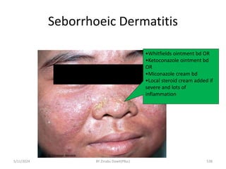 Seborrhoeic Dermatitis
5/11/2024 538
•Whitfields ointment bd OR
•Ketoconazole ointment bd
OR
•Miconazole cream bd
•Local steroid cream added if
severe and lots of
inflammation
BY Zinabu Dawit(PBsc)
 