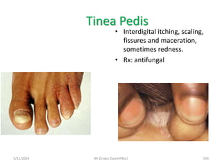 Tinea Pedis
5/11/2024 539
• Interdigital itching, scaling,
fissures and maceration,
sometimes redness.
• Rx: antifungal
BY Zinabu Dawit(PBsc)
 