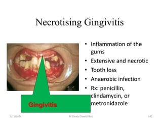 Necrotising Gingivitis
• Inflammation of the
gums
• Extensive and necrotic
• Tooth loss
• Anaerobic infection
• Rx: penicillin,
clindamycin, or
metronidazole
5/11/2024 542
Gingivitis
BY Zinabu Dawit(PBsc)
 