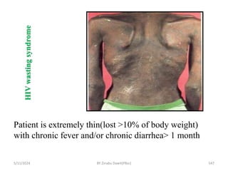 HIV
wasting
syndrome
Patient is extremely thin(lost >10% of body weight)
with chronic fever and/or chronic diarrhea> 1 month
5/11/2024 547
BY Zinabu Dawit(PBsc)
 