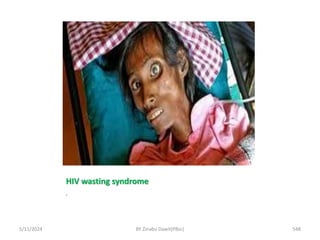 HIV wasting syndrome
.
5/11/2024 548
BY Zinabu Dawit(PBsc)
 
