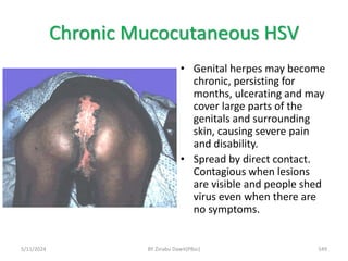 Chronic Mucocutaneous HSV
5/11/2024 549
• Genital herpes may become
chronic, persisting for
months, ulcerating and may
cover large parts of the
genitals and surrounding
skin, causing severe pain
and disability.
• Spread by direct contact.
Contagious when lesions
are visible and people shed
virus even when there are
no symptoms.
BY Zinabu Dawit(PBsc)
 