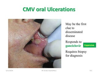 CMV oral Ulcerations
5/11/2024 551
May be the first
clue to
disseminated
disease
Responds to
ganciclovir
Requires biopsy
for diagnosis
Expensive!
BY Zinabu Dawit(PBsc)
 