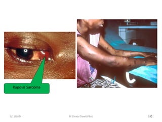 5/11/2024 552
Kaposis Sarcoma
BY Zinabu Dawit(PBsc)
 