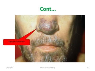 Cont...
5/11/2024 553
Kaposis Sarcoma
BY Zinabu Dawit(PBsc)
 