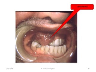 5/11/2024 554
Lymphoma
BY Zinabu Dawit(PBsc)
 