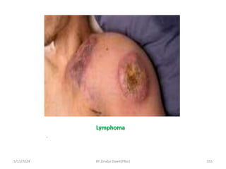 Lymphoma
.
5/11/2024 555
BY Zinabu Dawit(PBsc)
 